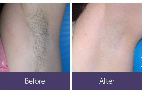 Client before and after laser hair removal result