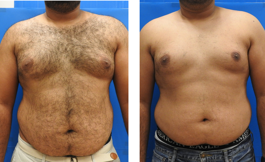 Client before and after laser hair removal result