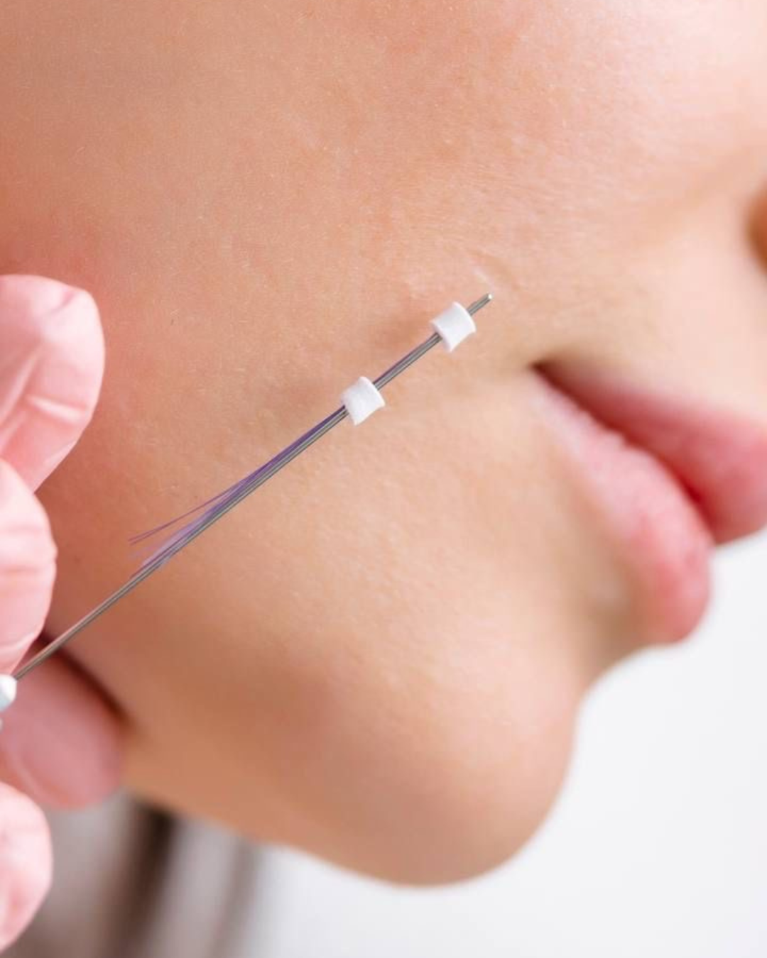 Los hilos bioestimuladores  concón