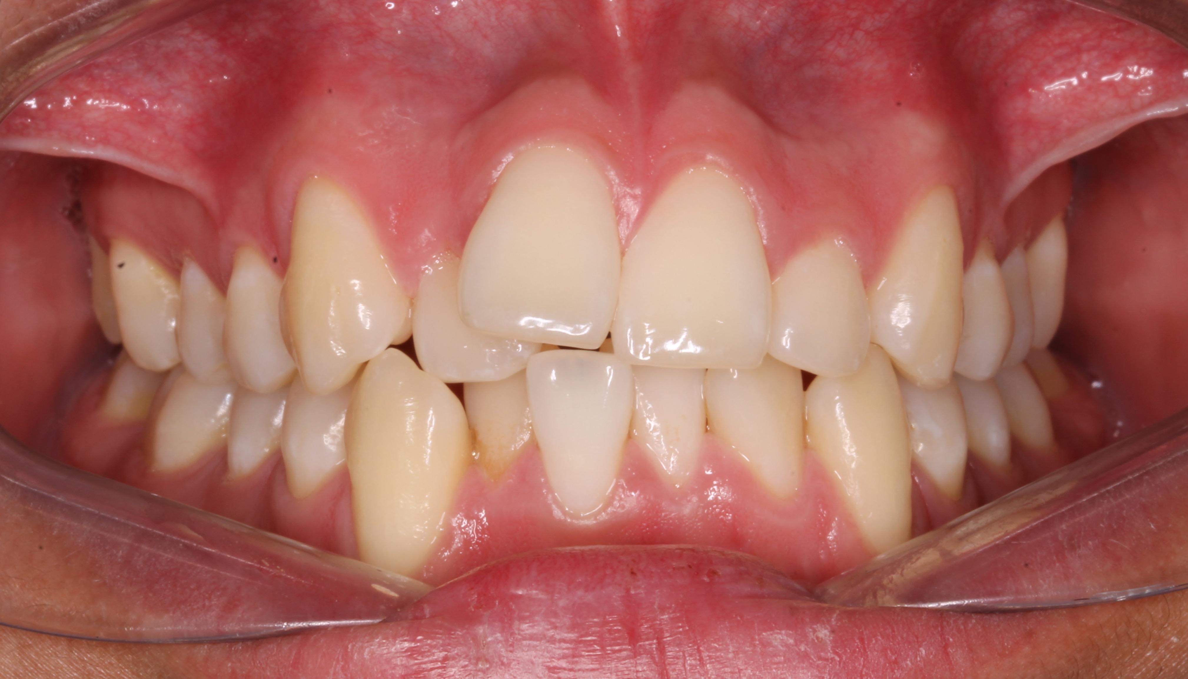 Antes del tratamiento