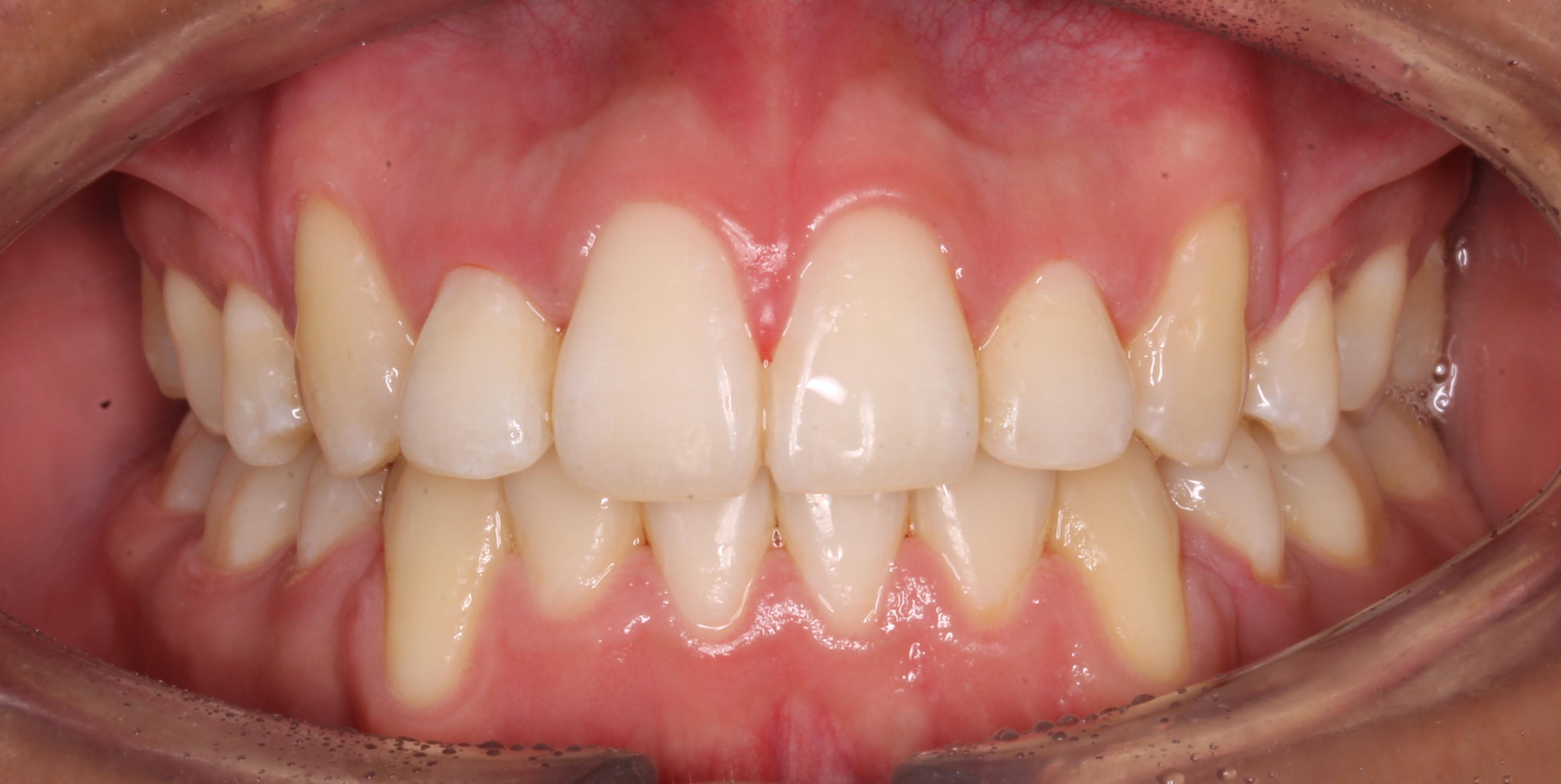 Resultado final del tratamiento