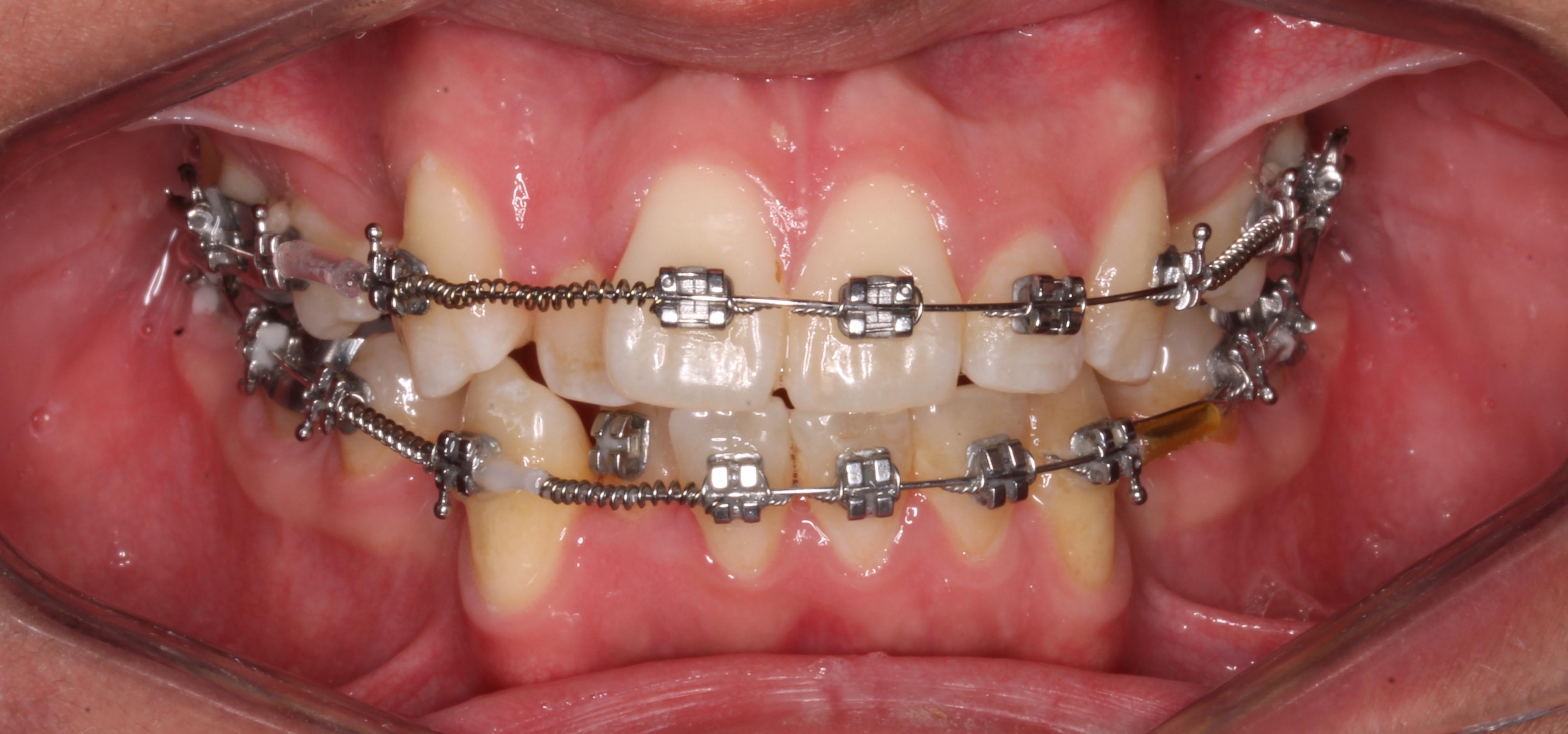 Durante el tratamiento