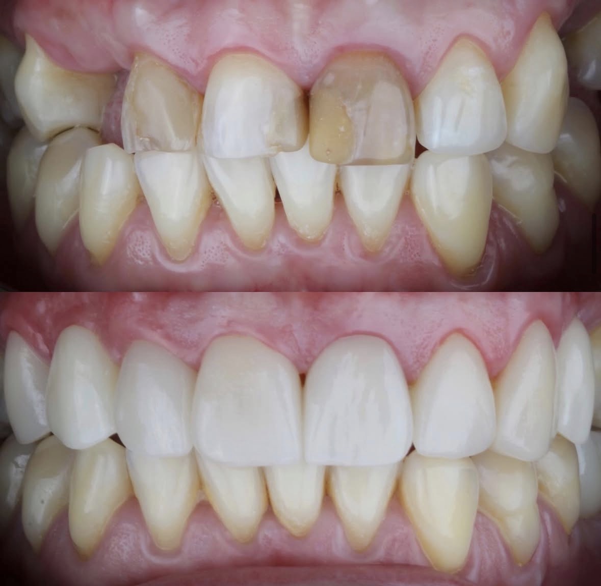 Implantes dentales antes y después