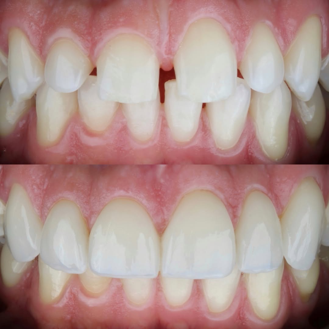 Carillas dentales antes y después 1