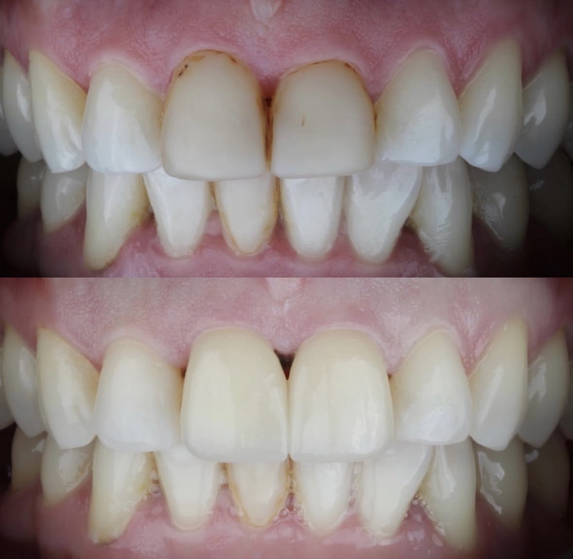 Carillas dentales antes y después 2