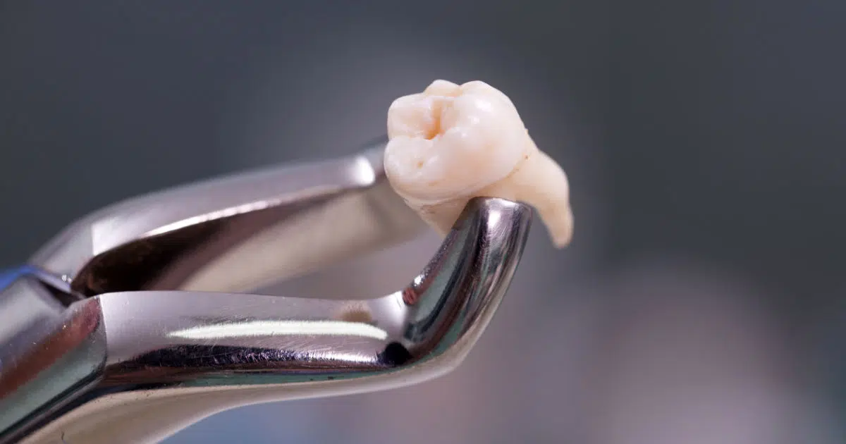 Exodoncia Simple — Corona Bucal