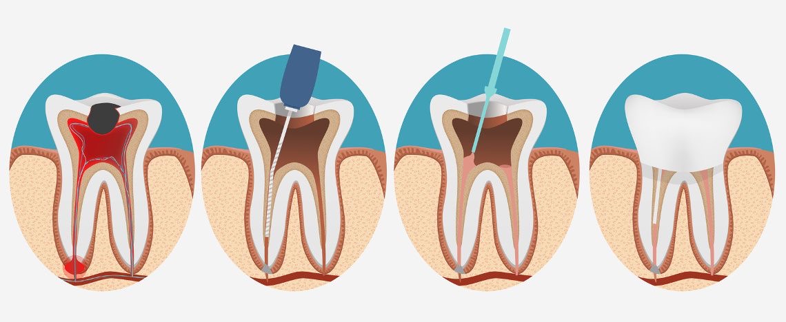 Procedimiento de endodoncia en Clínica Dental