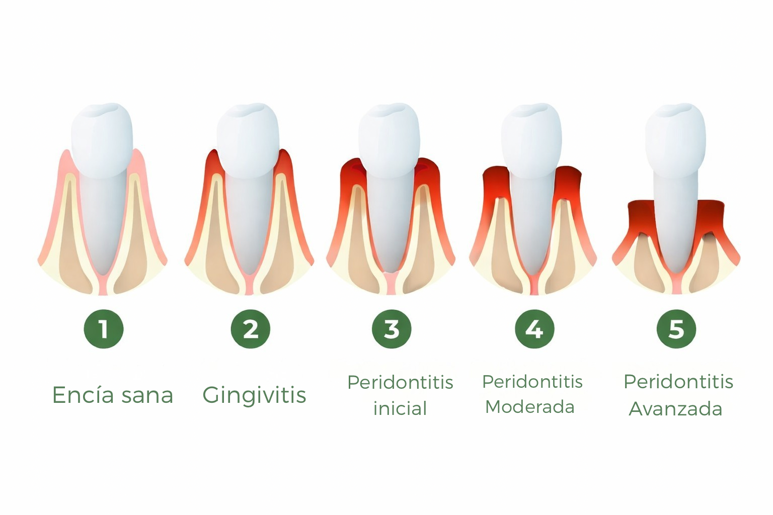 Evolución de la periodontitis