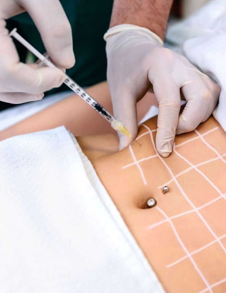 hidrolipoclasia con enzimas