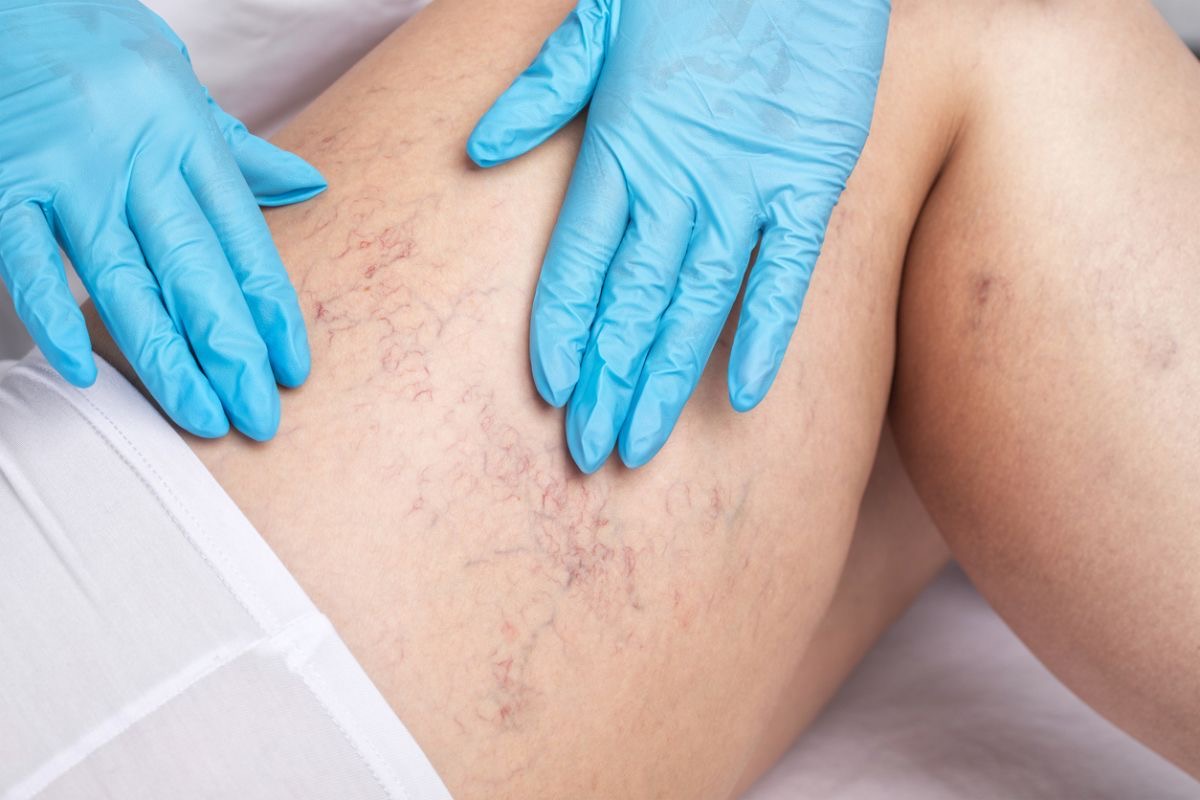 PEIM — Tratamiento de Arañitas Vasculares — Evi Alves