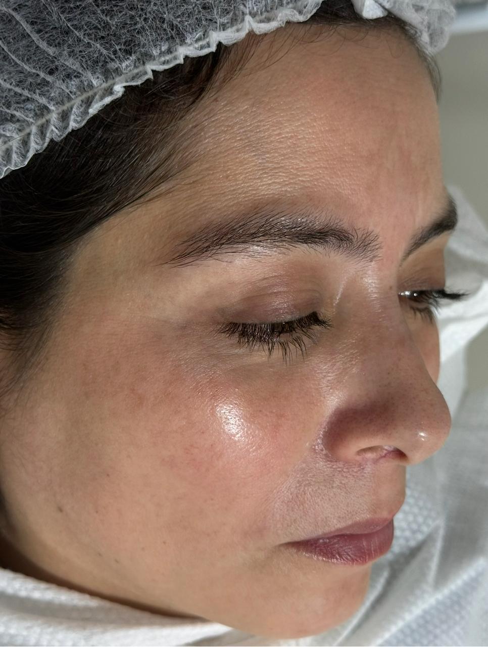 Después — Melasma