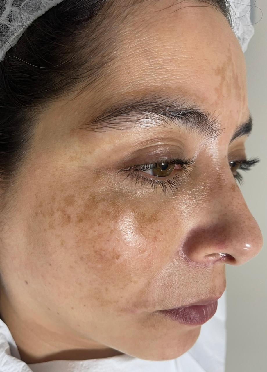 Antes — Melasma