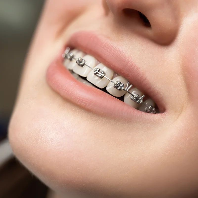 Ortodoncia invisible OyE Dental La Reina