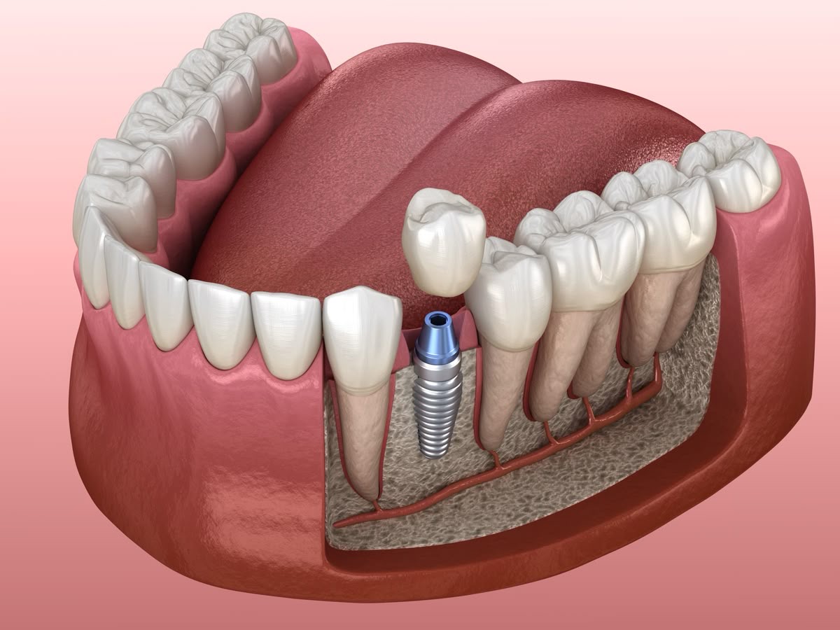 Implantología OyE Dental La Reina