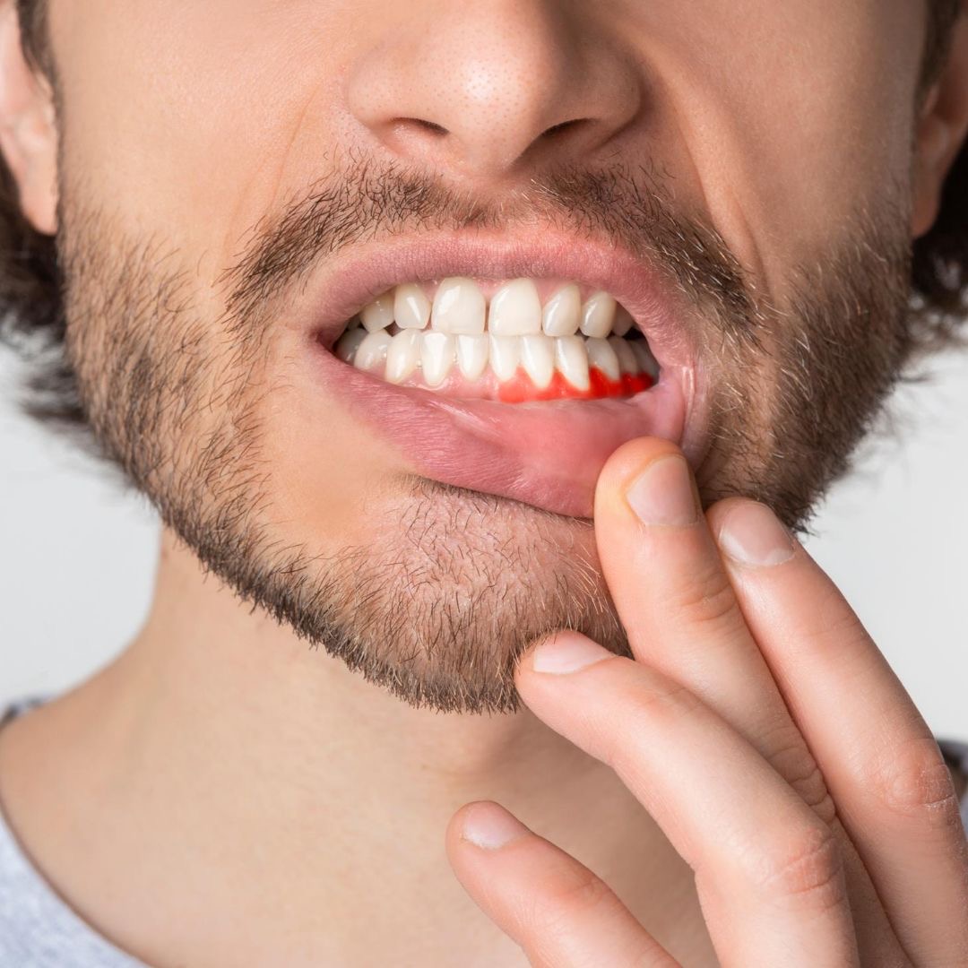Periodoncia OyE Dental La Reina