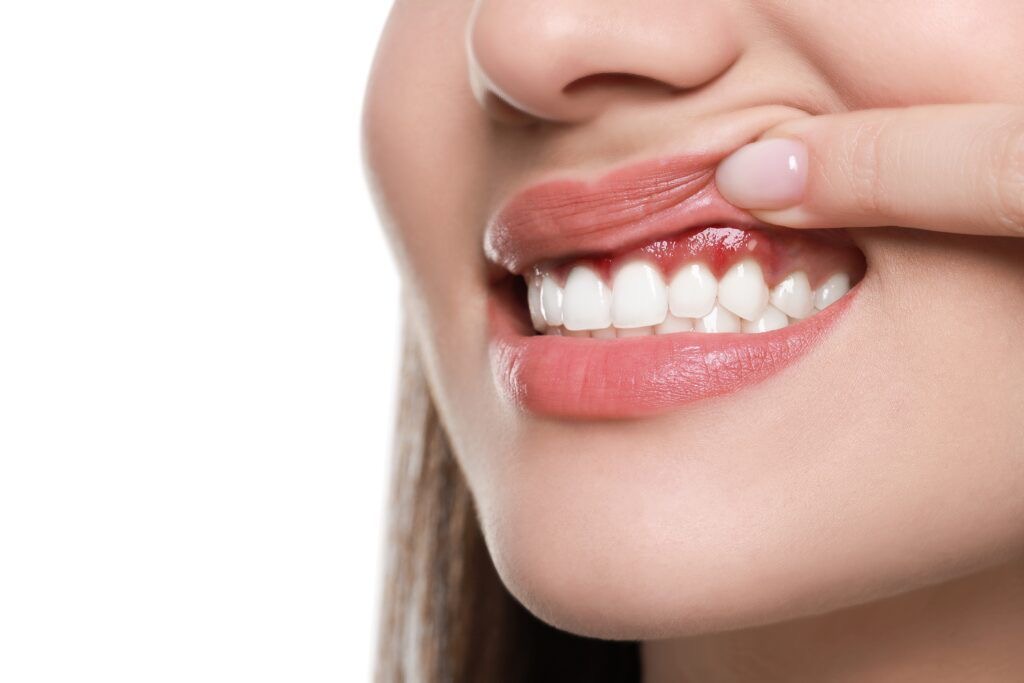 Tratamiento de encías OyE Dental La Reina