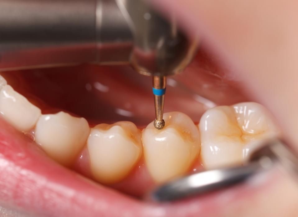 Tratamiento de conducto OyE Dental La Reina