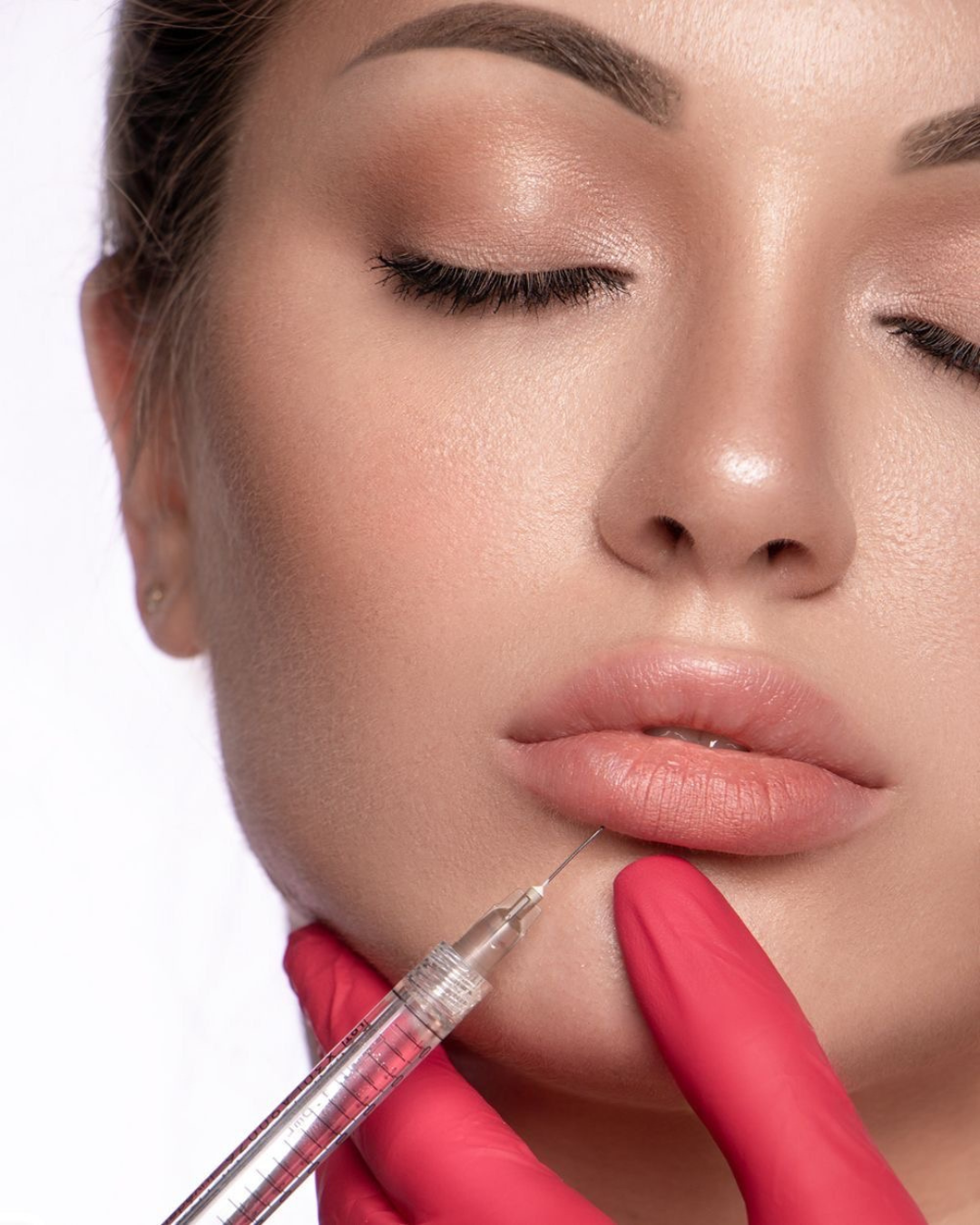 aumento de labios con acido hialuronico concón