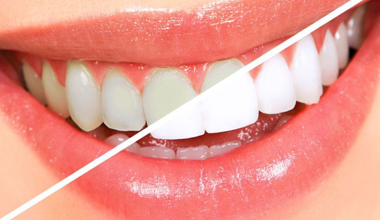 Woman with teeth whitening