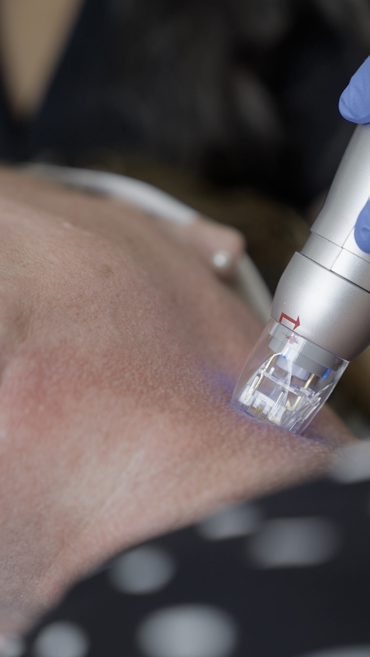 Scarlet RF Microneedling Treatment