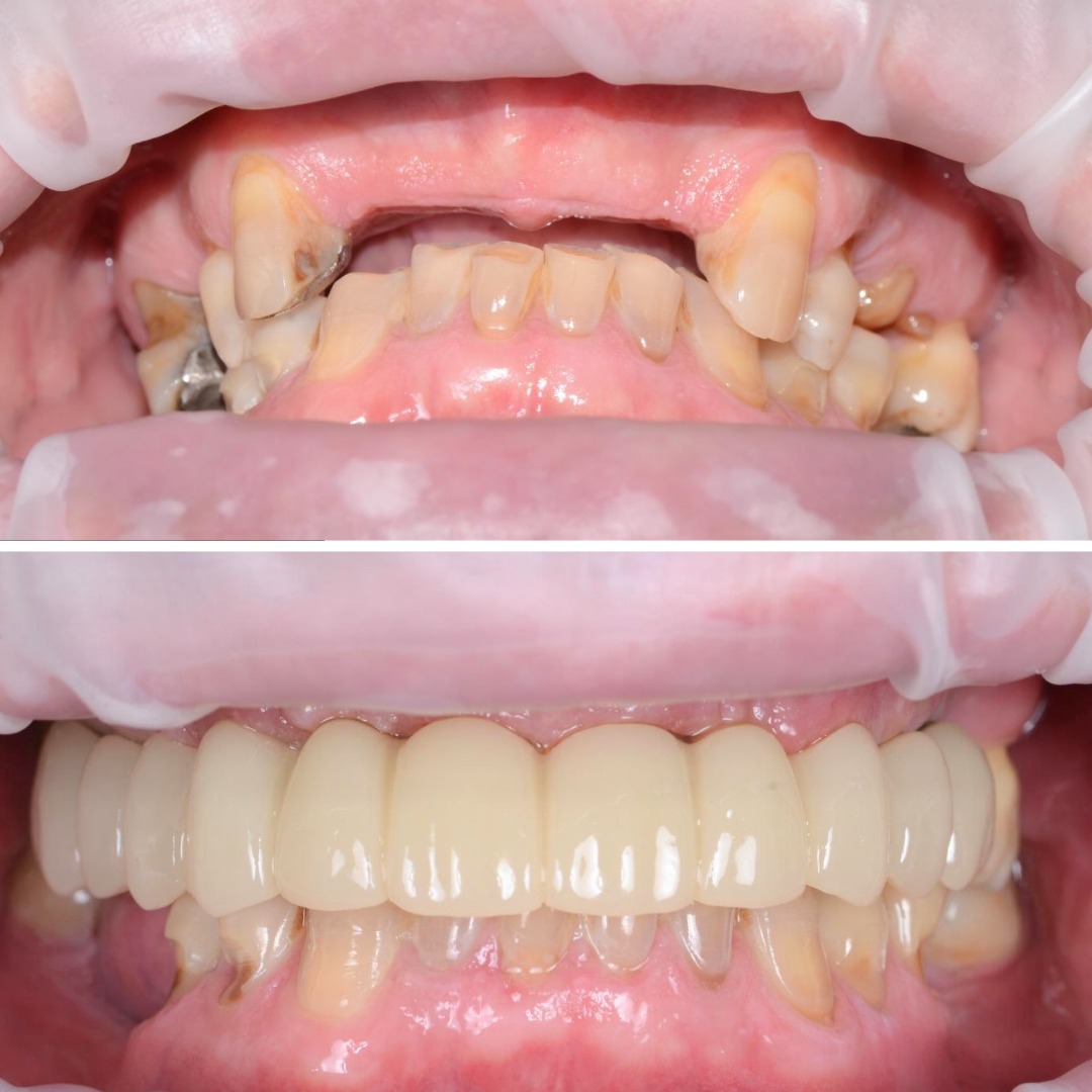 Before and after full arch implants
