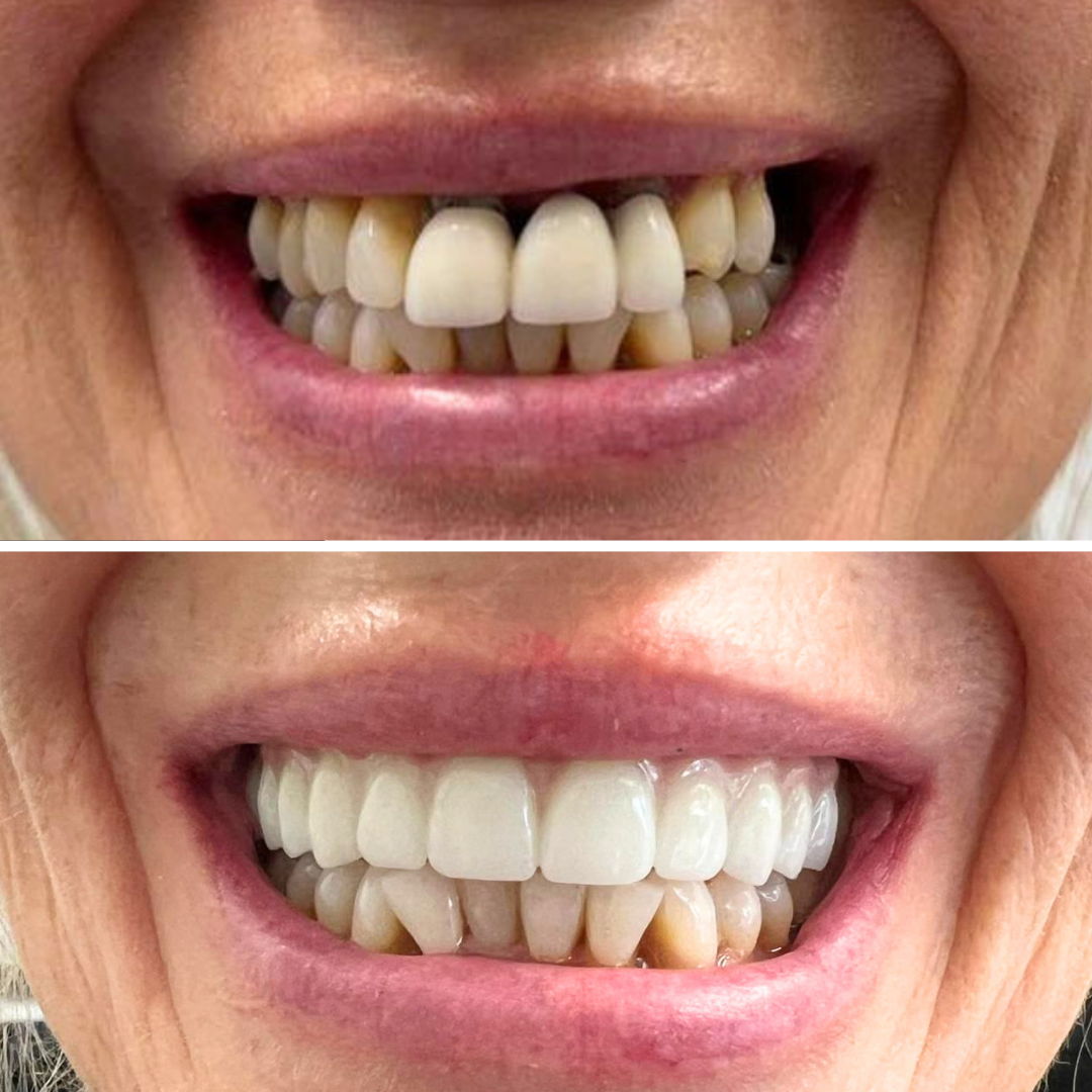 Before and after full arch implants