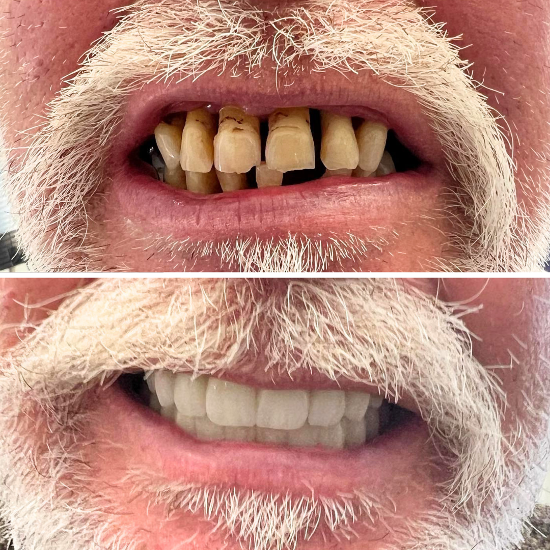 Before and after full arch implants