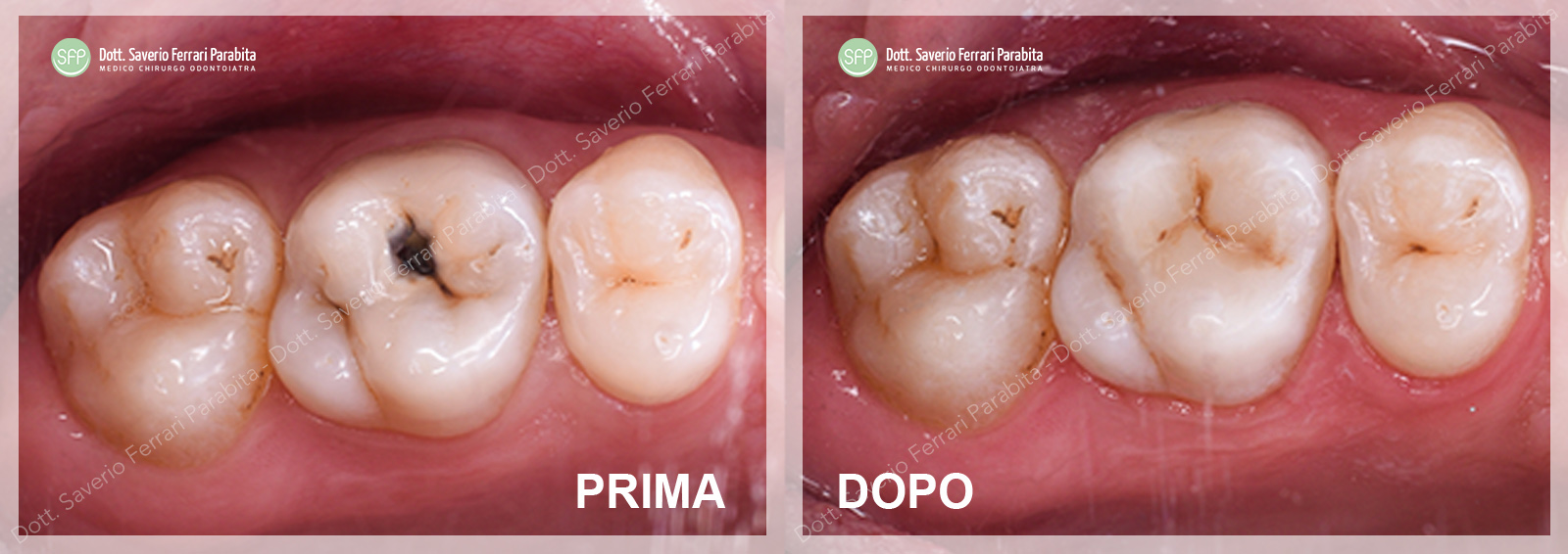 Caso reale: riabilitazione protesica, prima e dopo — SFP Dental Service Versilia