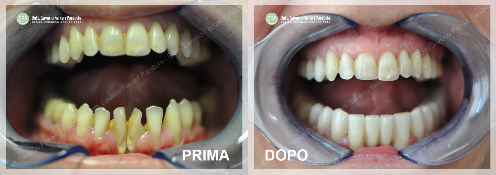 Caso reale: impianto dentale completo, prima e dopo — SFP Dental Service Versilia