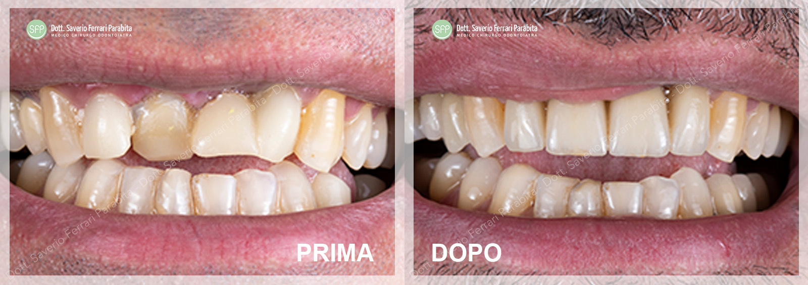 Caso reale: implantologia avanzata, prima e dopo — SFP Dental Service Versilia