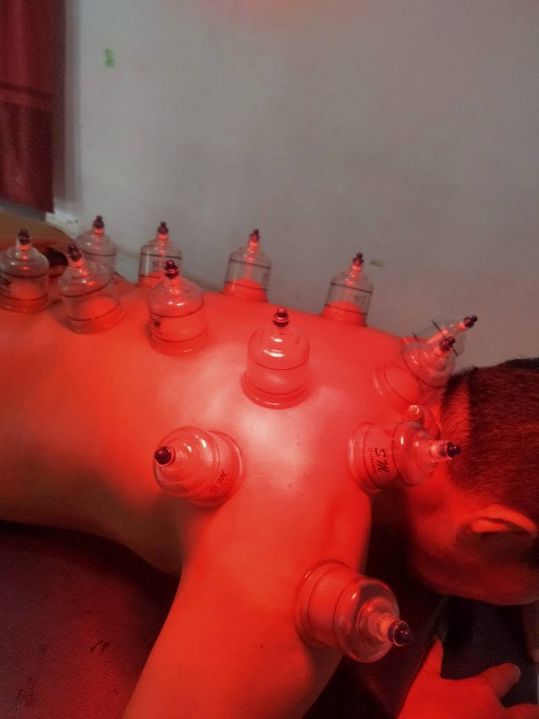 Aktivitas Bekam dengan pendamping penggunaan infrared di RUMAH TERAPI ALFA, Pemangkat