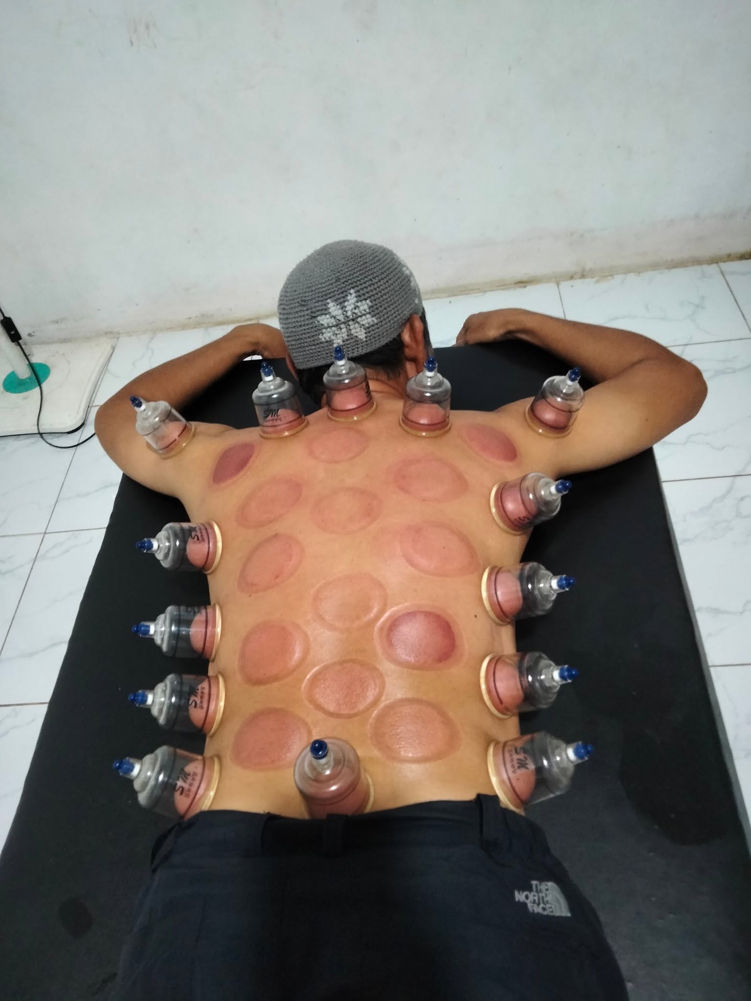Aktivitas Bekam di RUMAH TERAPI ALFA, Pemangkat