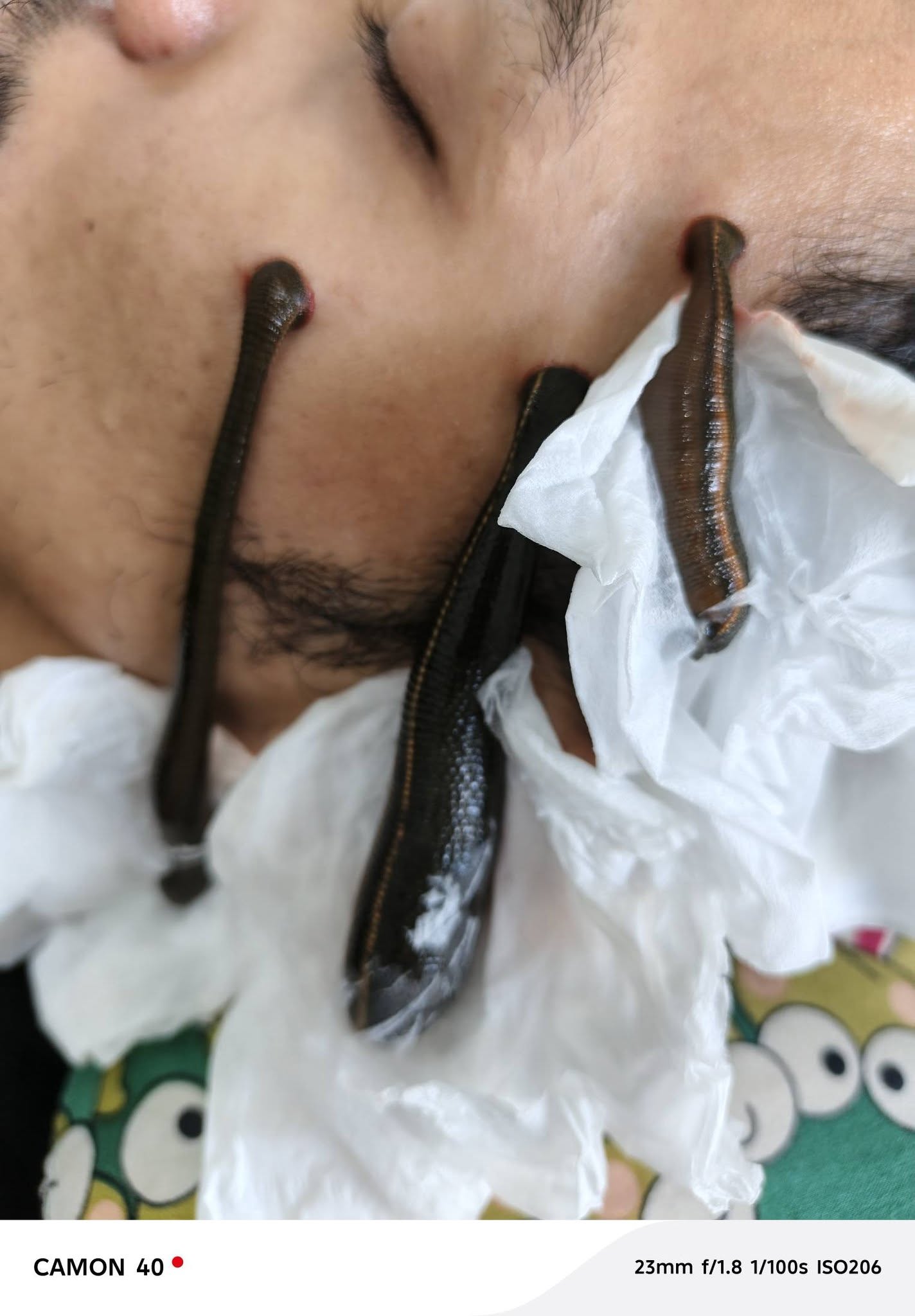 Aktivitas Terapi Lintah di RUMAH TERAPI ALFA, Pemangkat