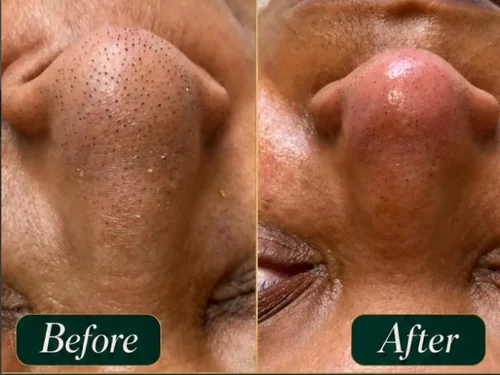 Clogged Pore Facial Treatment Jacksonville