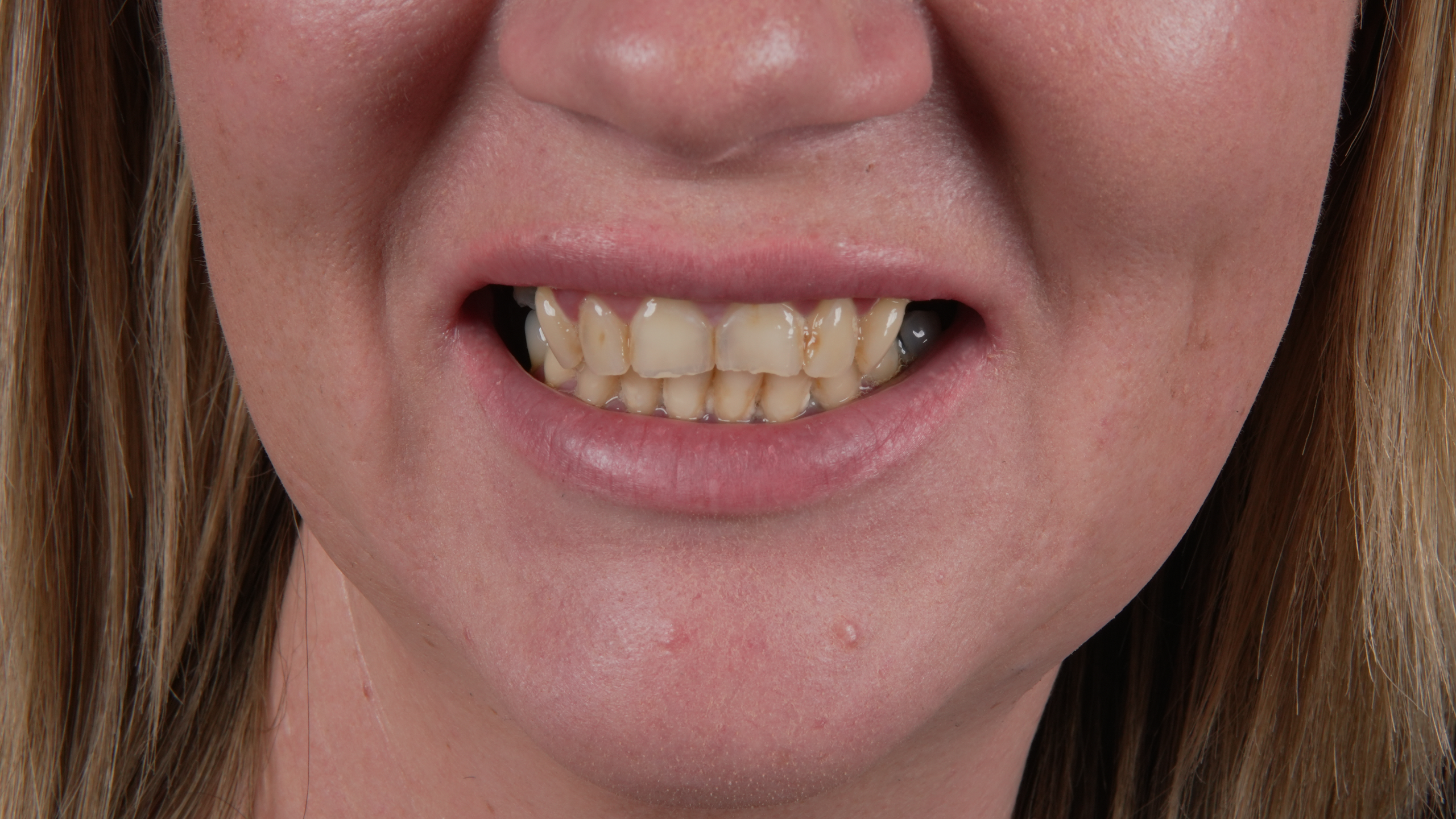 After All-on-6 Full Mouth Restoration