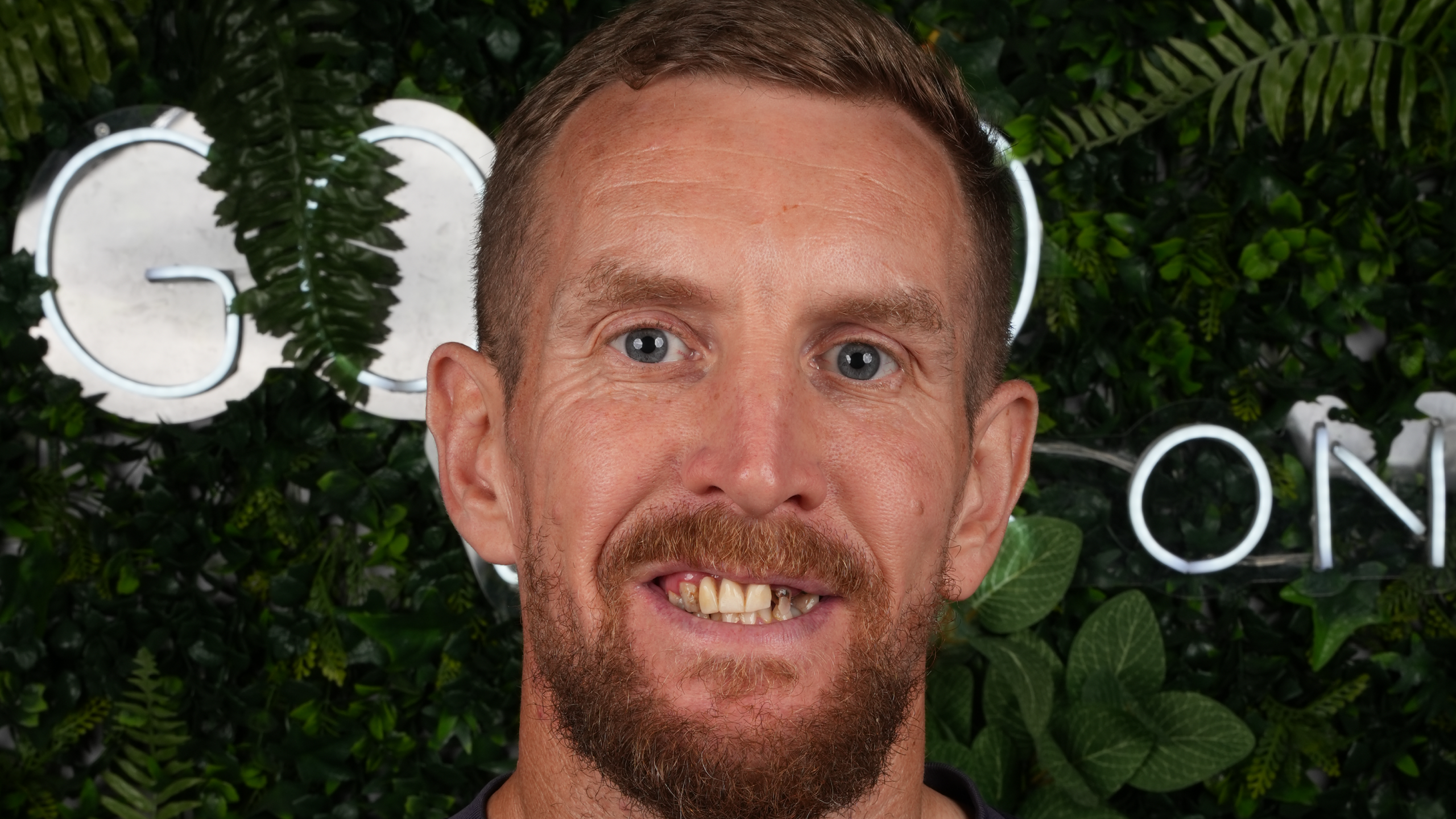 After All-on-6 Full Mouth Restoration