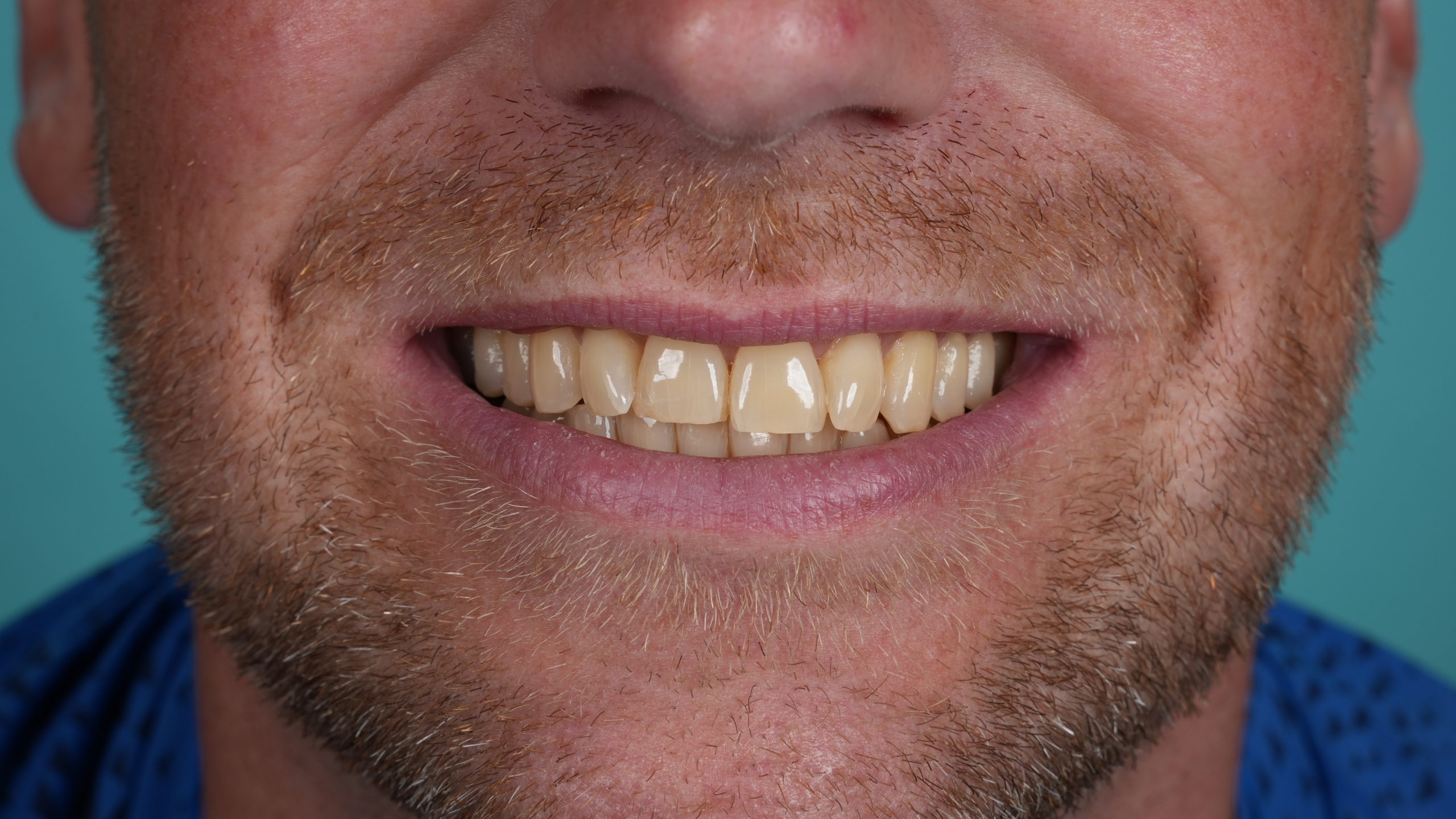 After 25 Zirconium Crowns