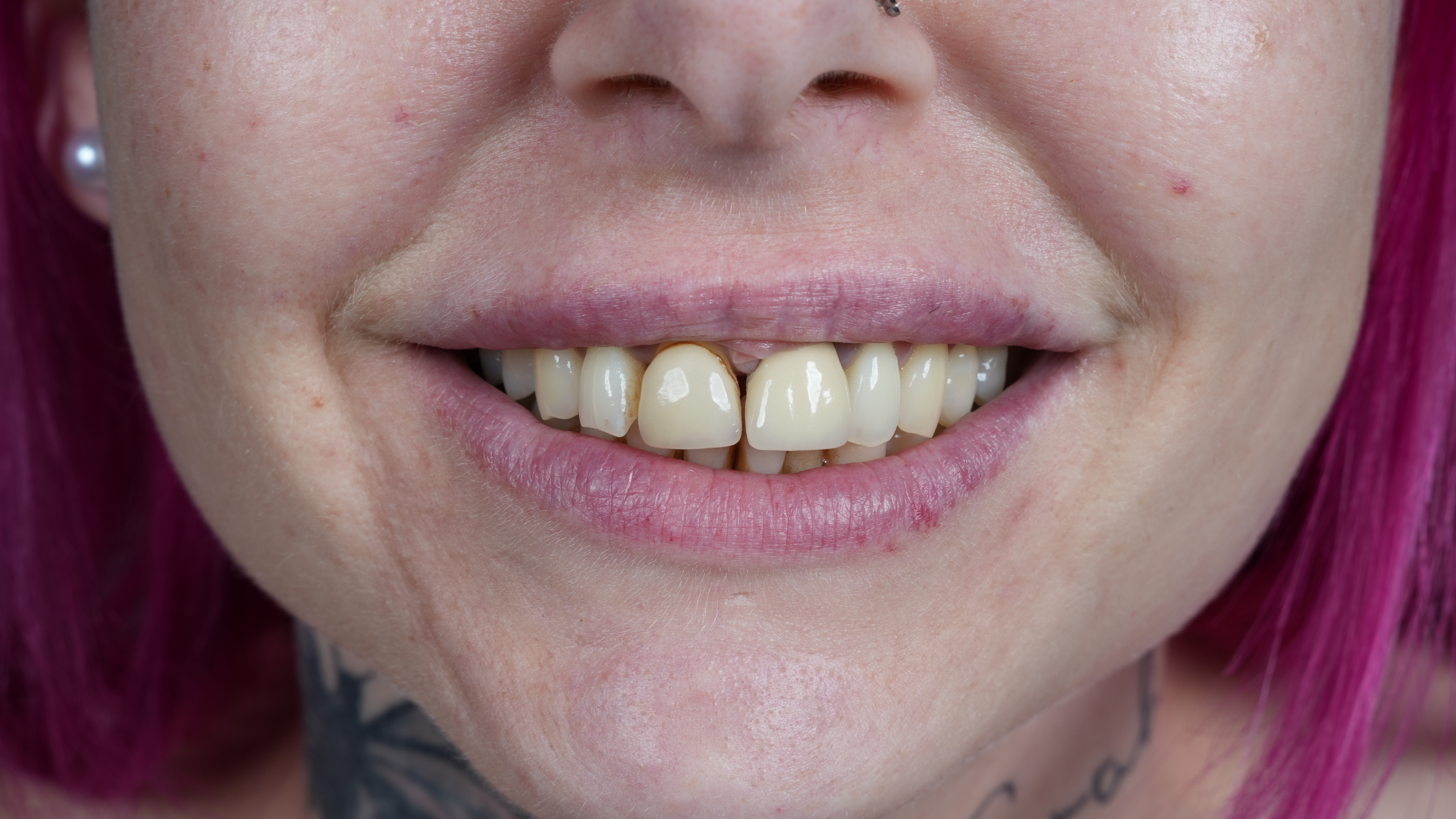 After 20 Zirconium Crowns