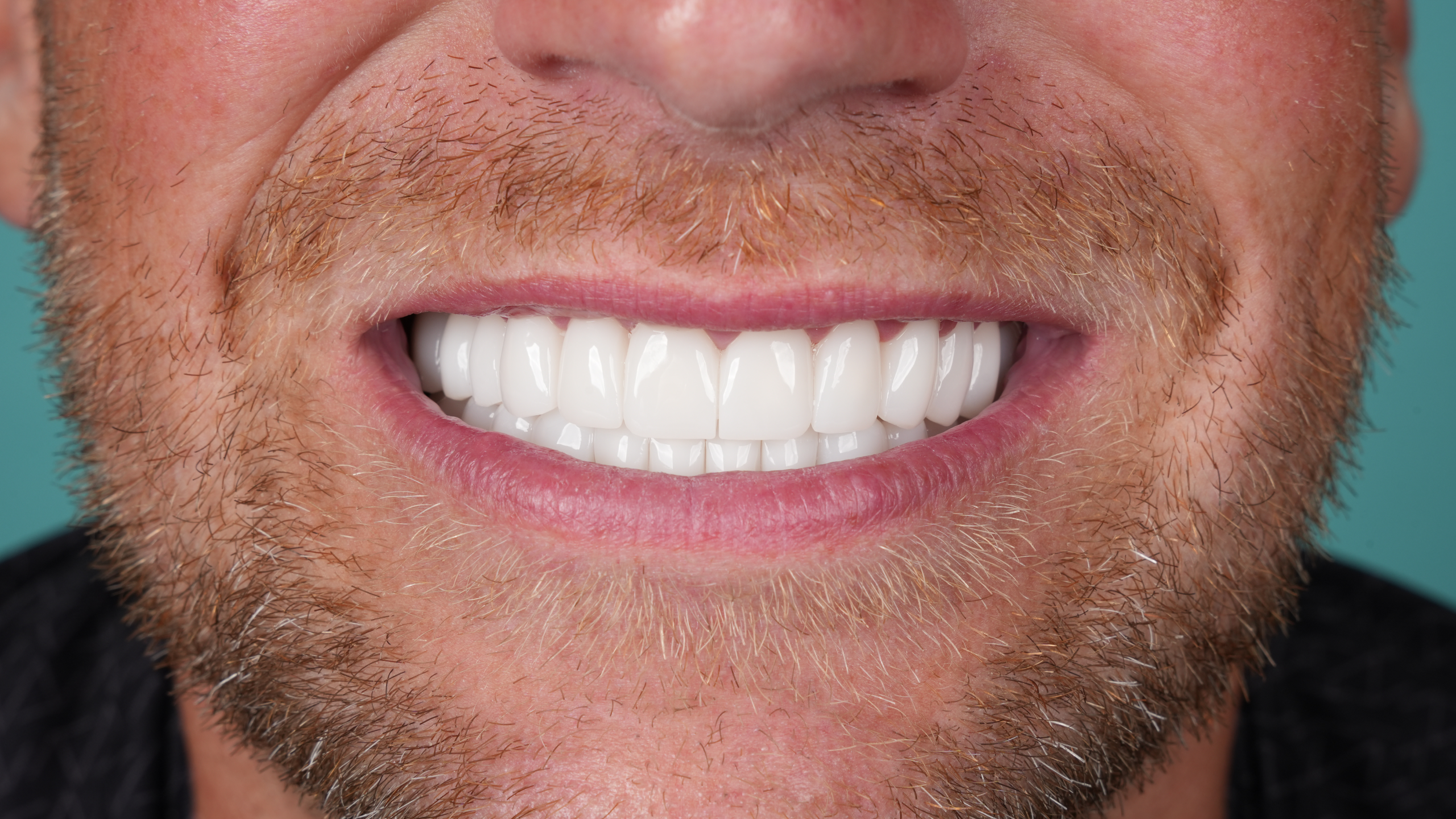 Before 25 Zirconium Crowns