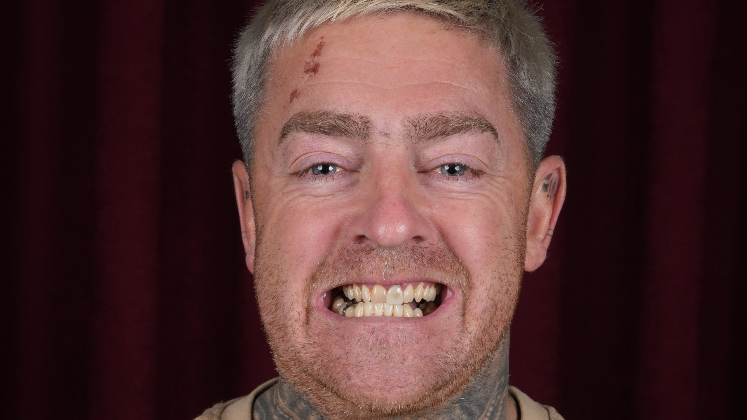 Before All-on-6 Full Mouth Restoration