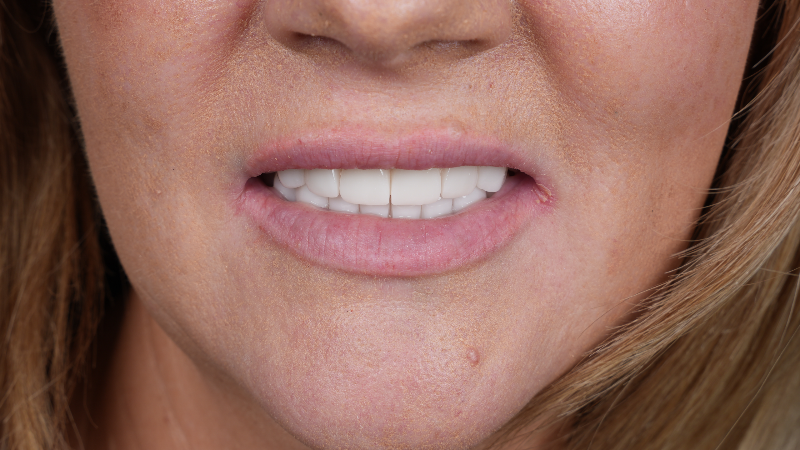 Before All-on-6 Full Mouth Restoration