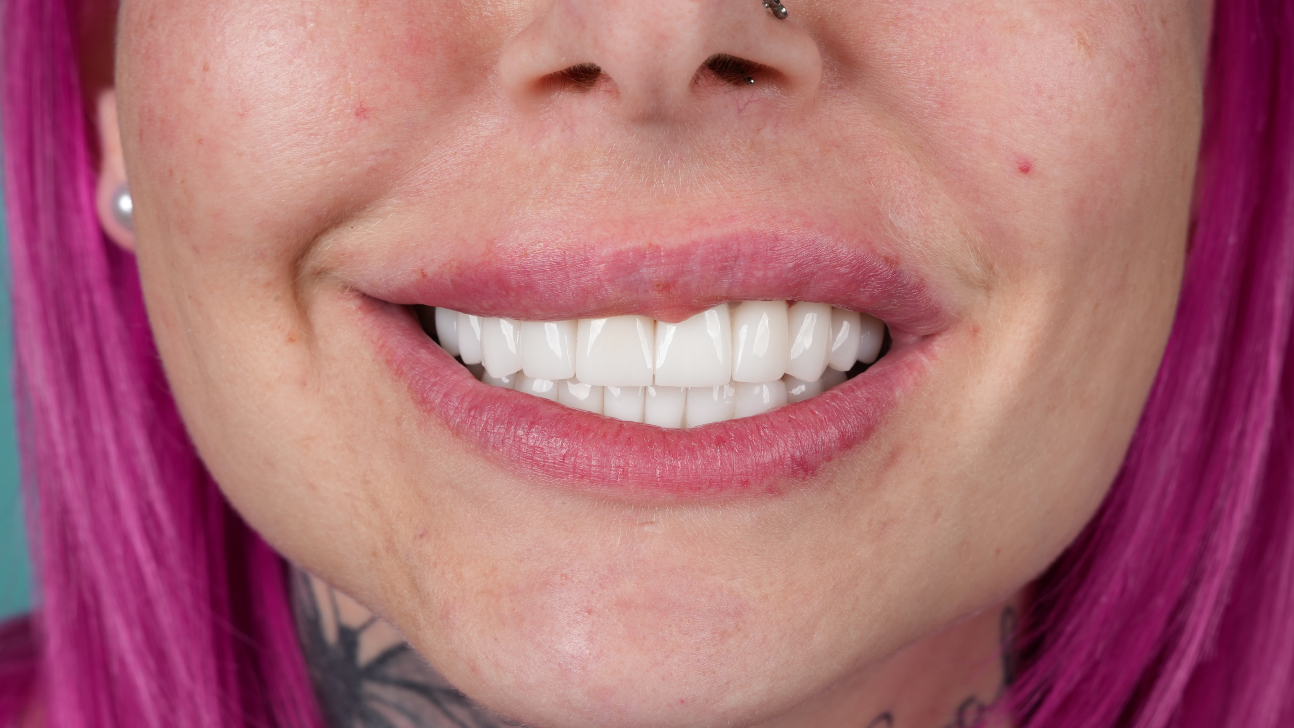 Before 20 Zirconium Crowns