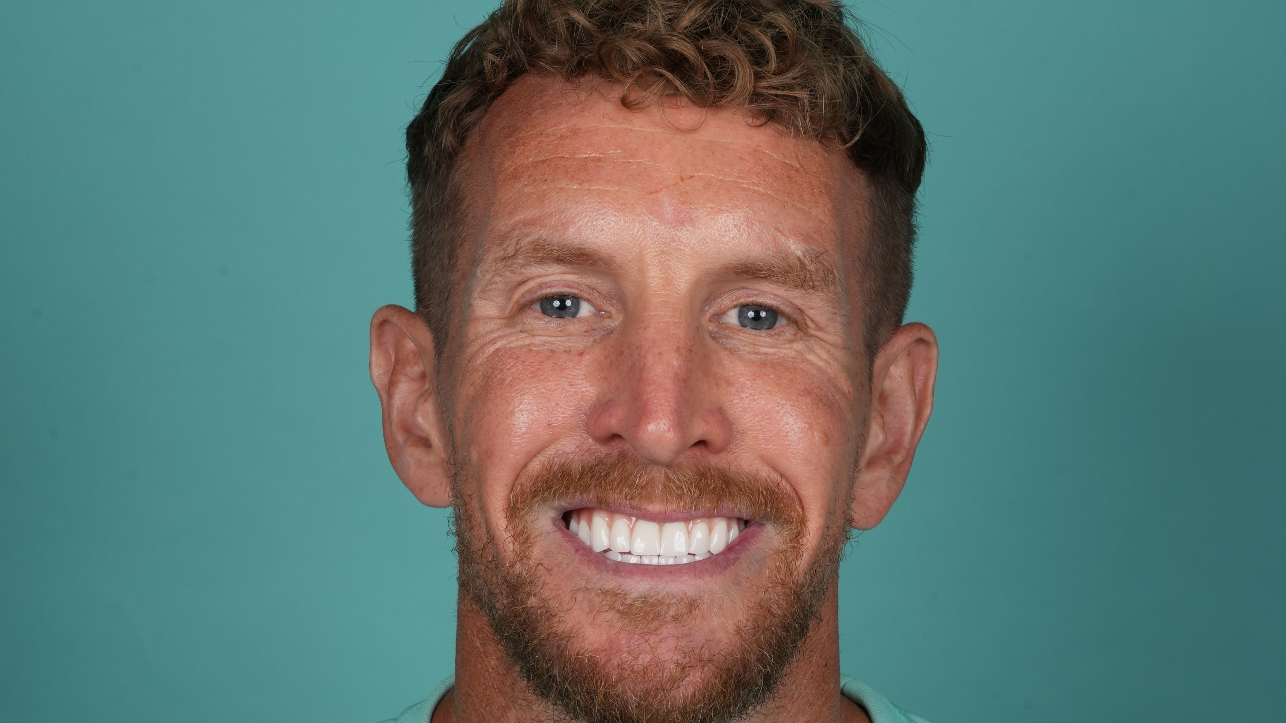 Before All-on-6 Full Mouth Restoration
