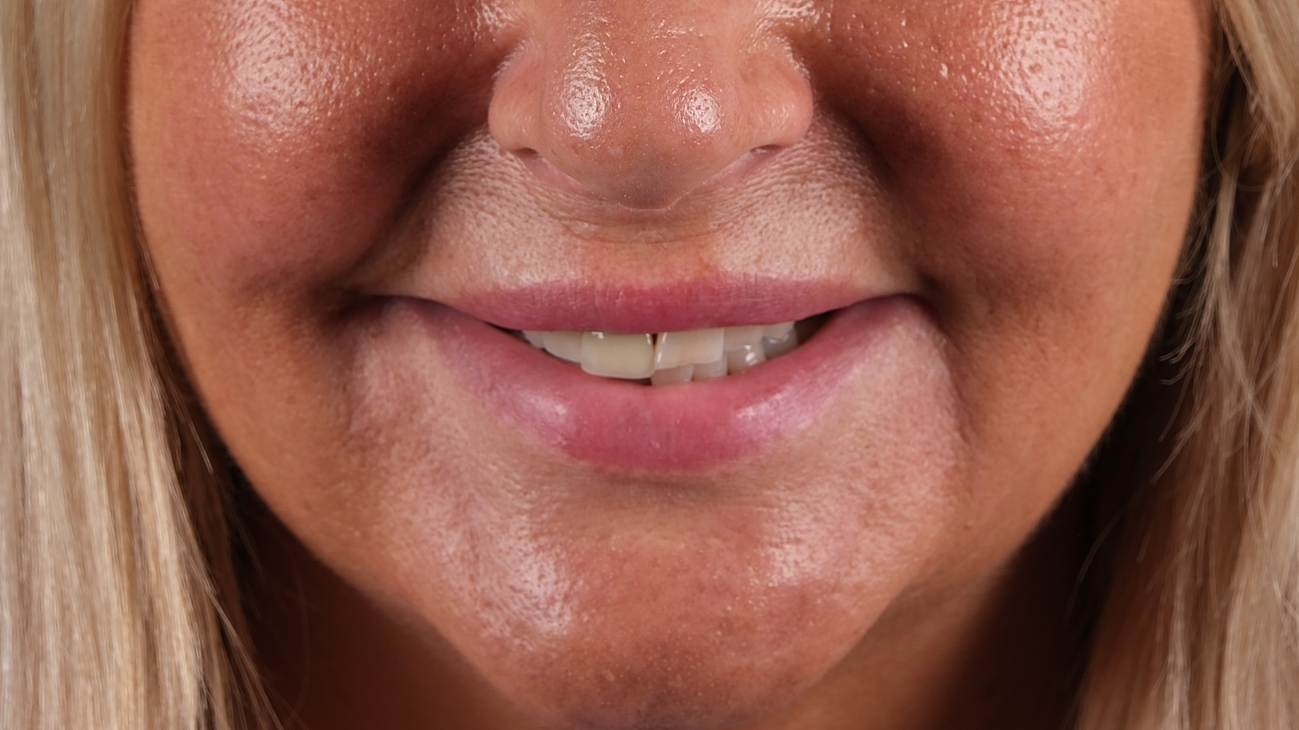 Before All-on-6 Full Mouth Restoration