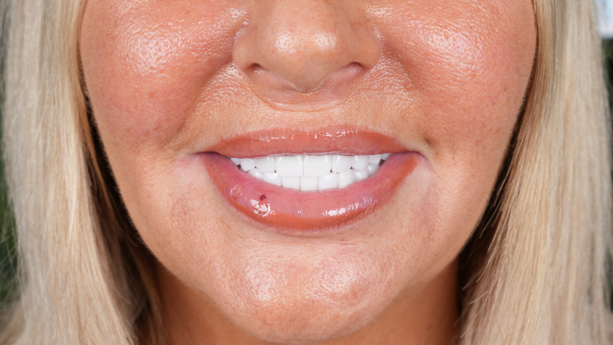 After All-on-6 Full Mouth Restoration