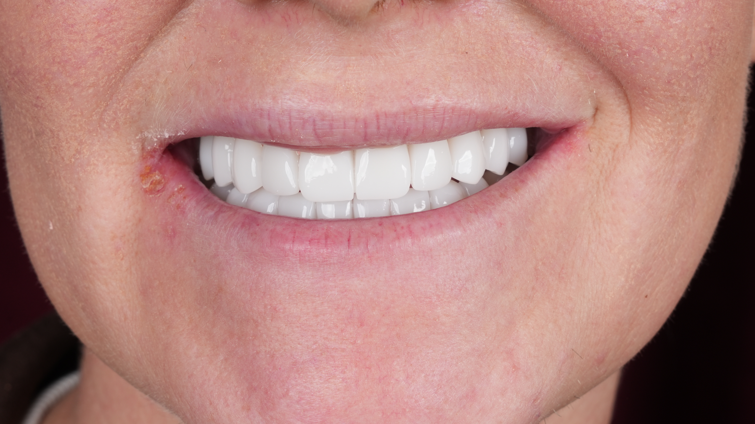 After All-on-6 Full Mouth Restoration