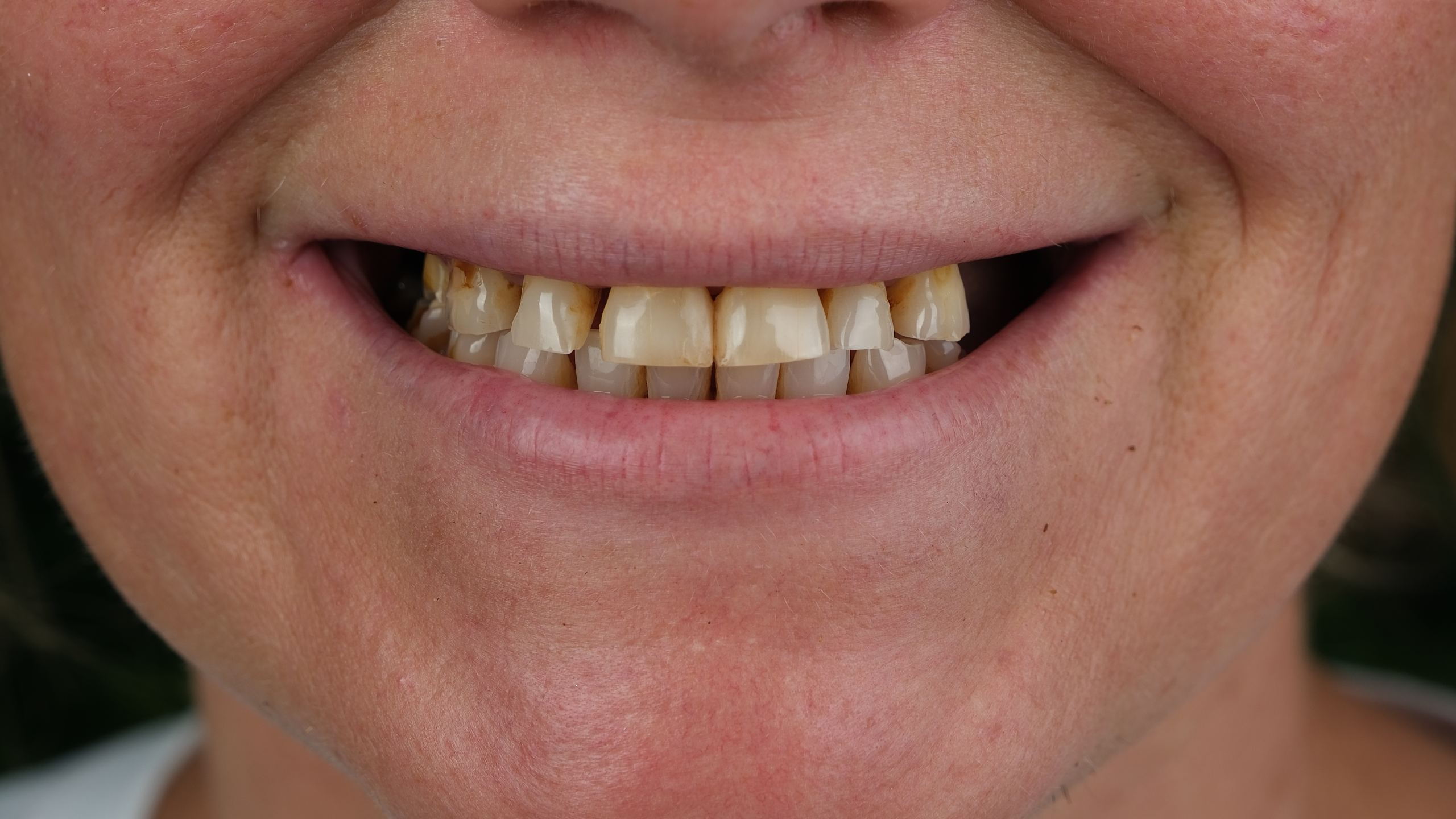 Before All-on-6 Full Mouth Restoration