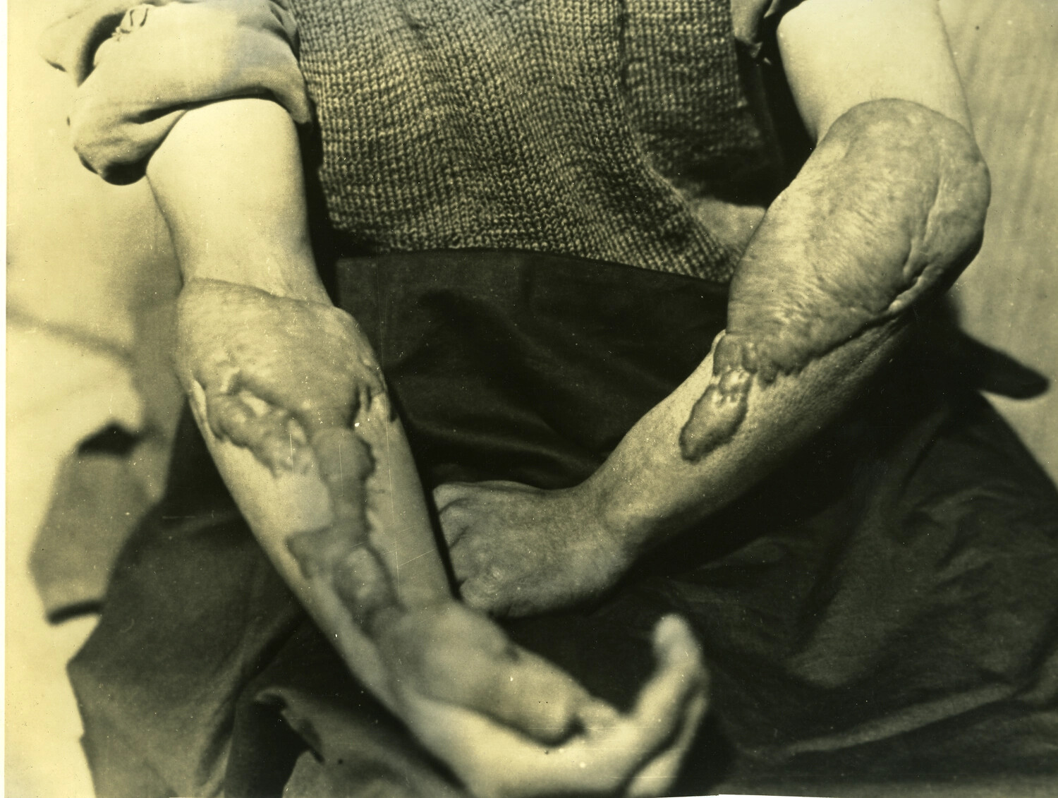 Medical Documentation Photograph of Severe Burn Scarring and Keloid Formation on a Survivor's Forearms, Japan, Post-1945