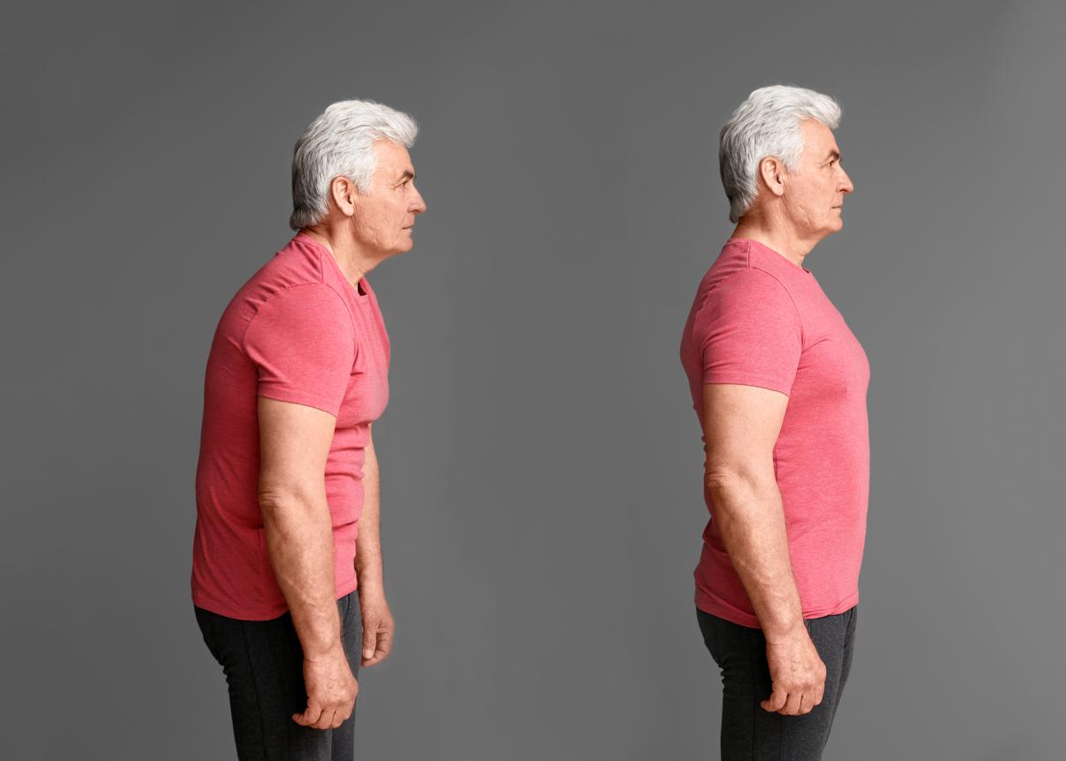Forward head posture vs correct posture in older adult side view showing kyphosis, rounded shoulders and spinal alignment.