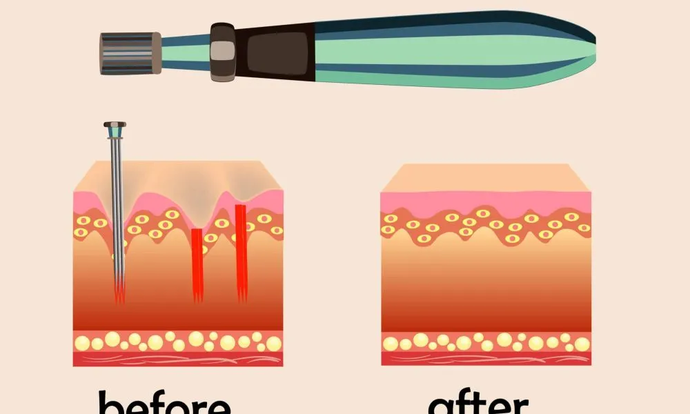 Before and after effect, Microneedle stamping device, collagen induction therapy, Cloud 9 MedSpa in Casa Grande, AZ
